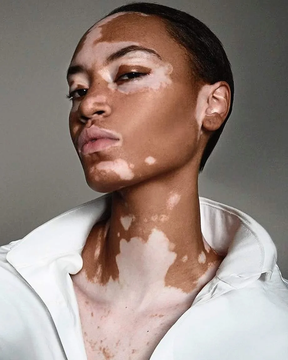 What Is Vitiligo? Causes, Symptoms, and Treatment Options