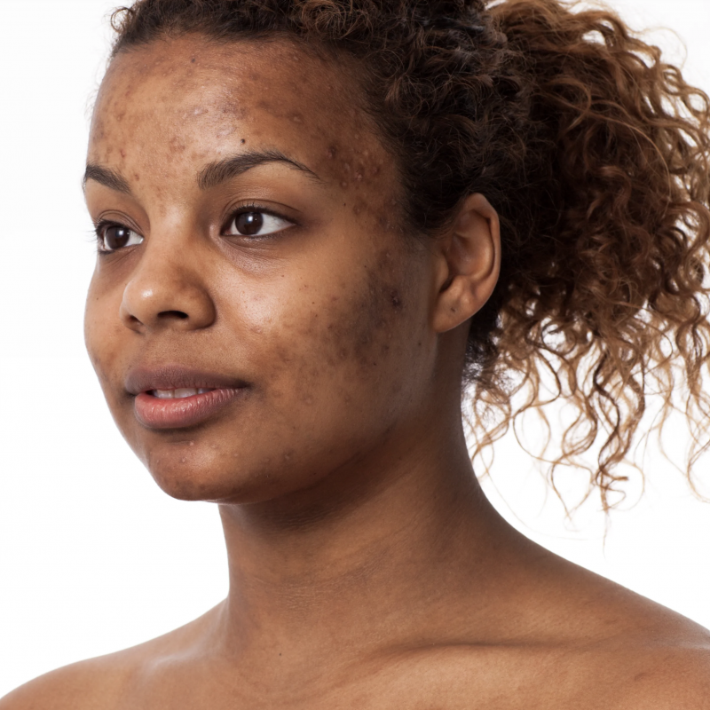 Understanding Hypopigmentation: Why Skin Loses Its Colour