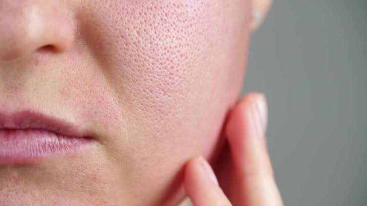 Skin Purging or a Breakout? How to Tell What Your Skin Is Actually Doing